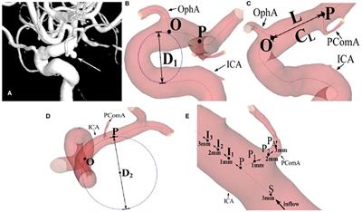 Associations Between Posterior Communicating Artery Aneurysms and Morphological Characteristics of Surrounding Arteries